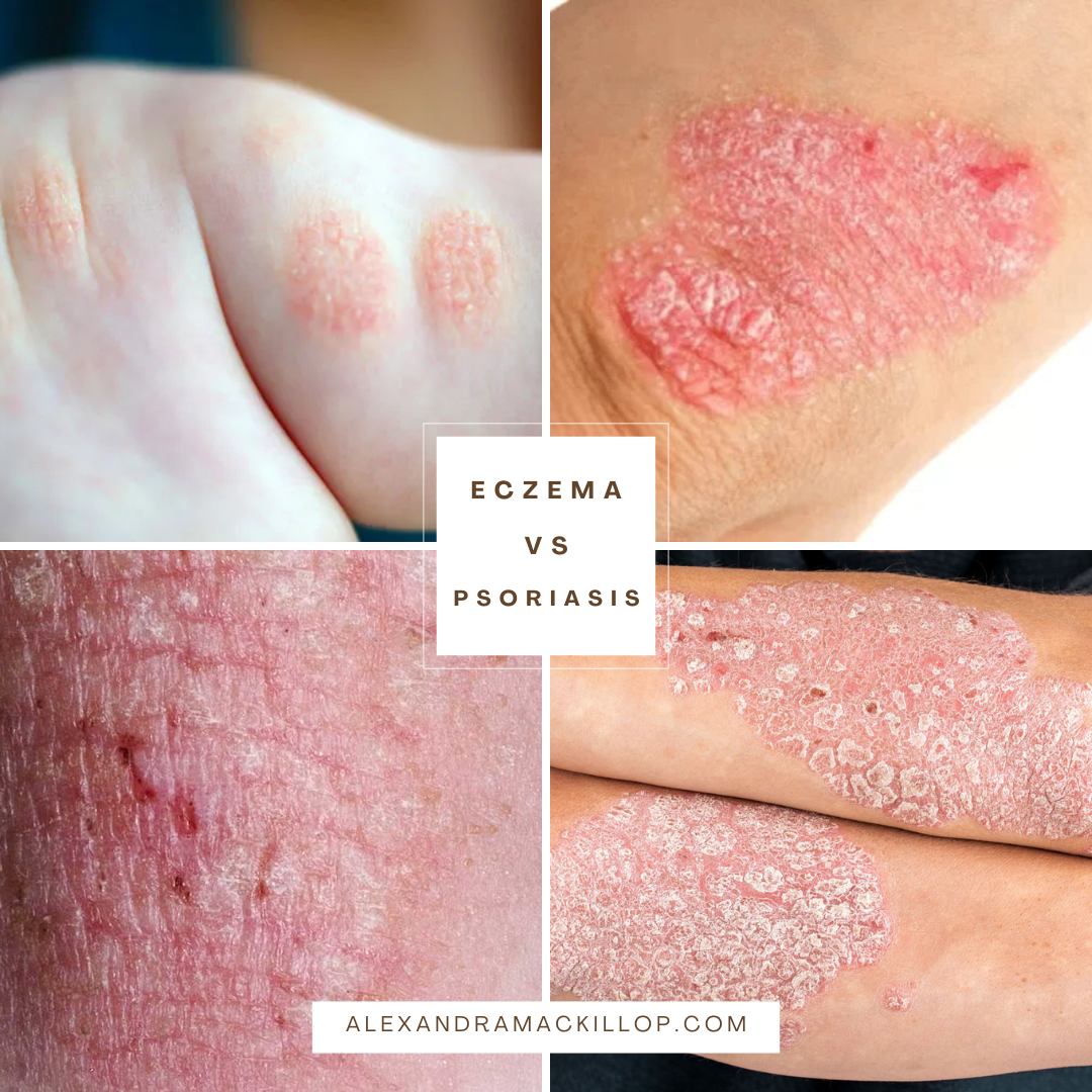 Psoriasis vs Eczema: Diagnosis and Treatment Through Functional Medicine